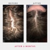 irestore-pro-laser-hair-growth-system-sverige-harvaxt-mot-haravfall-6