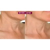 science-serum-tight-neck-clinical-anti-aging-neck-serum-smart-gel-sverige-fore-efter-before-after-2